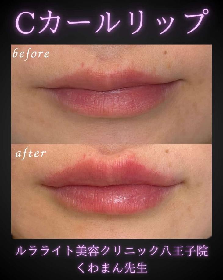 Ｃカールリップの症例写真