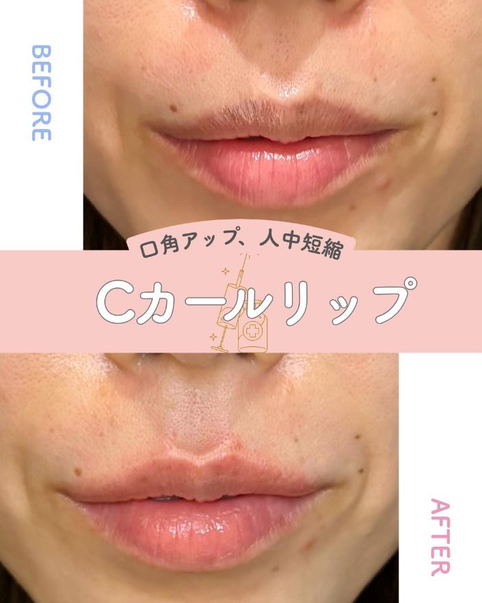 Ｃカールリップの症例写真