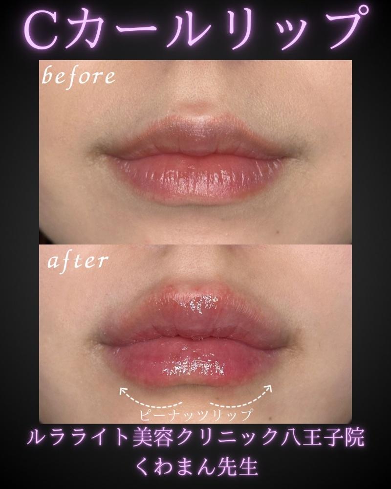 Ｃカールリップの症例写真