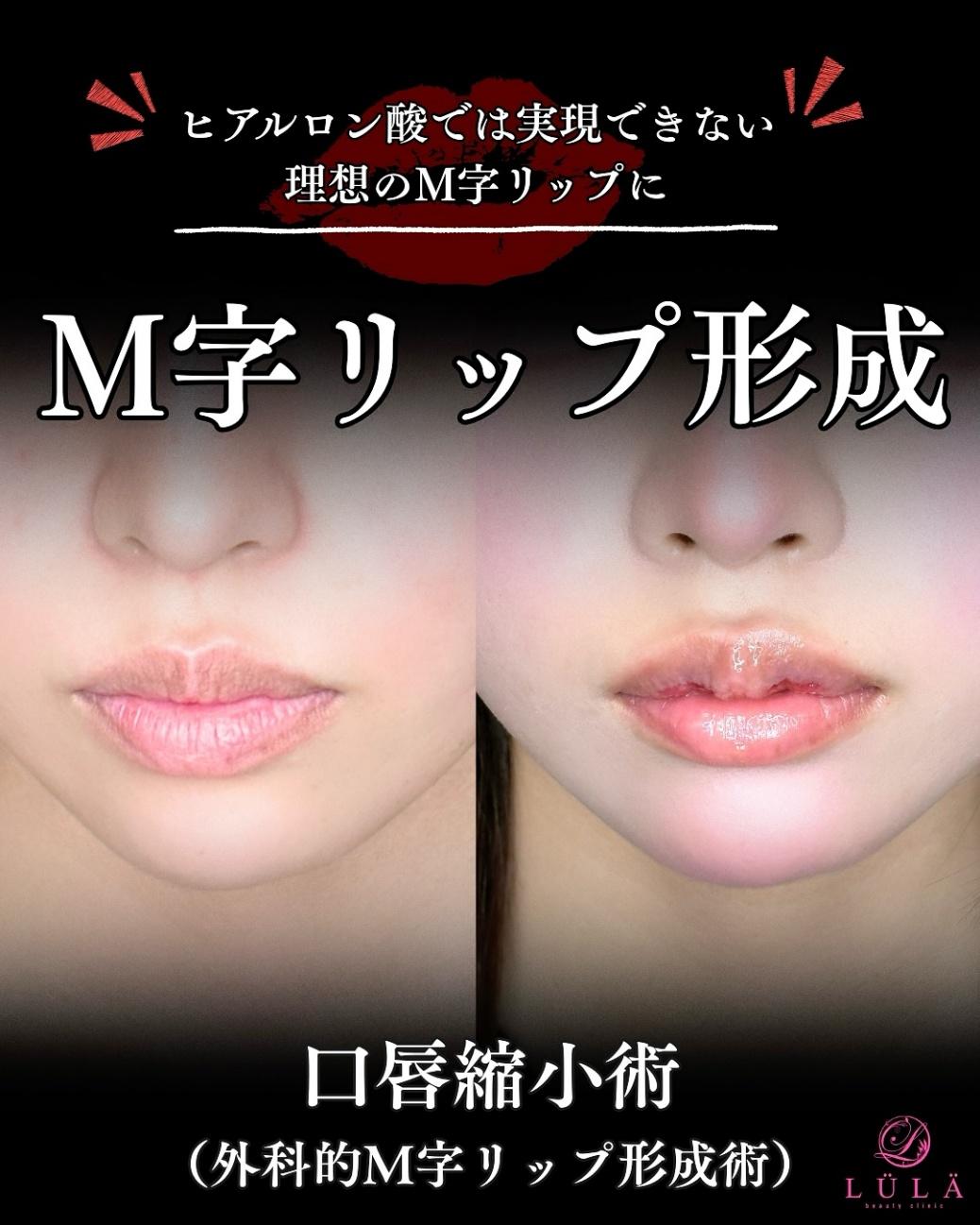口唇縮小術