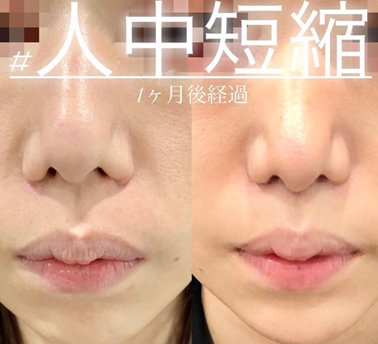 人中短縮手術(リフトアップ)の症例写真