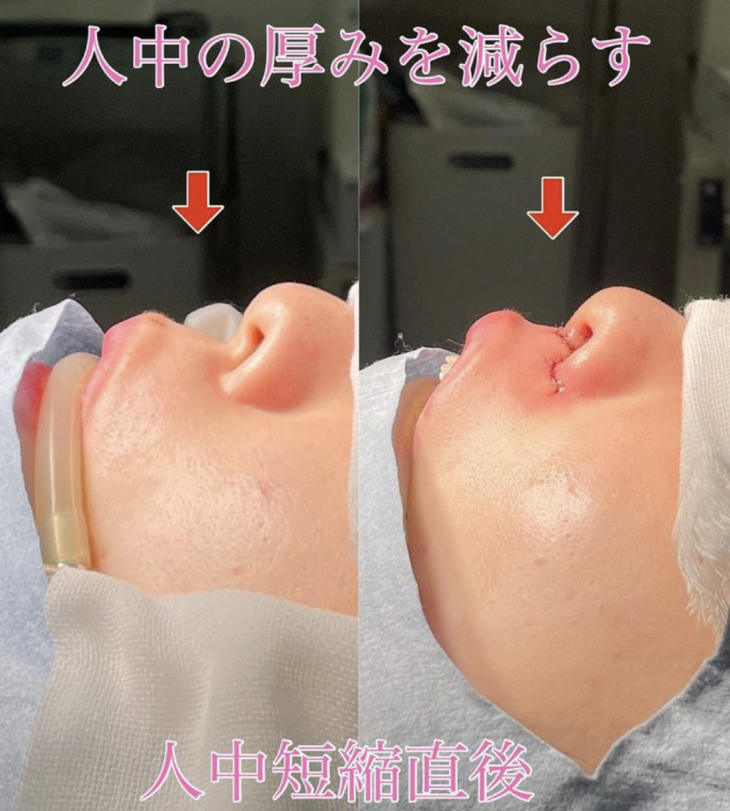 人中短縮手術(リフトアップ)の症例写真