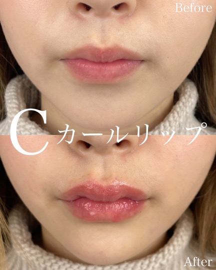 Cカールリップの症例写真