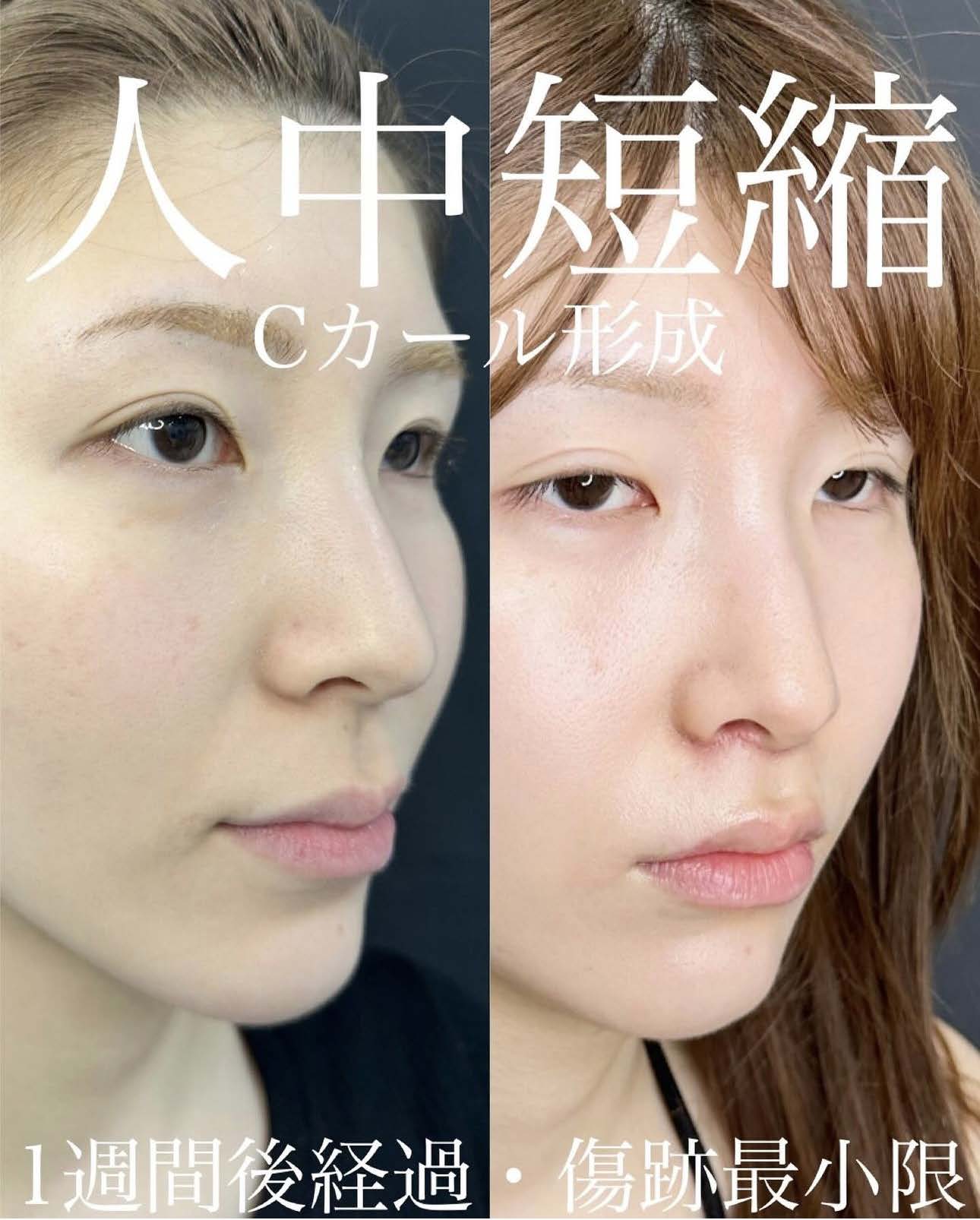 人中短縮手術(リフトアップ)の症例写真
