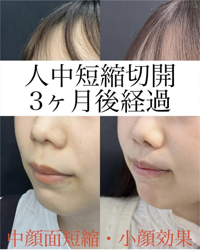 人中短縮手術(リフトアップ)の症例写真