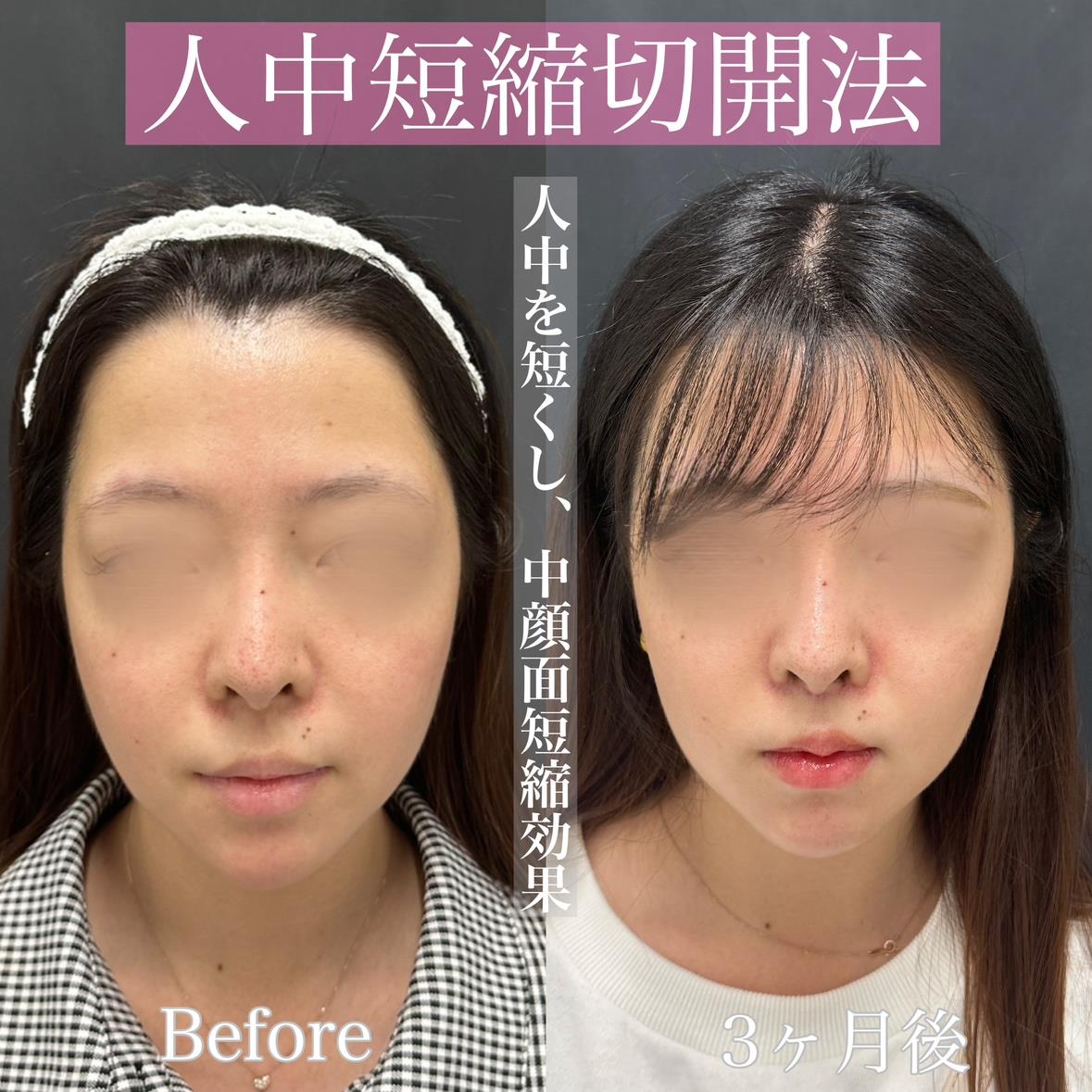 人中短縮手術(リフトアップ)の症例写真