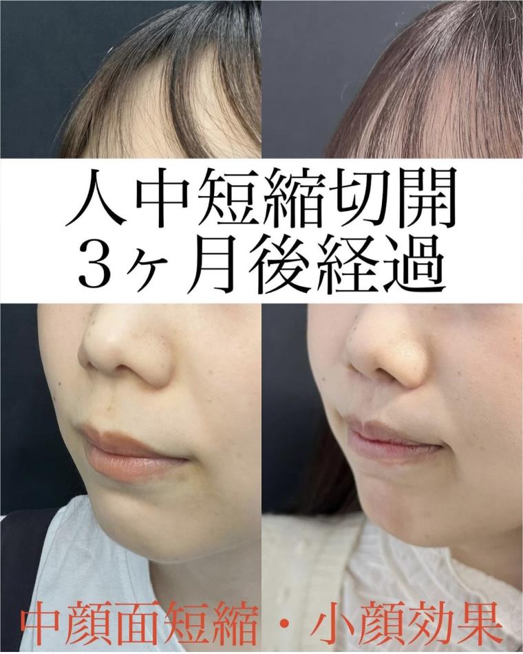 人中短縮手術(リフトアップ)の症例写真