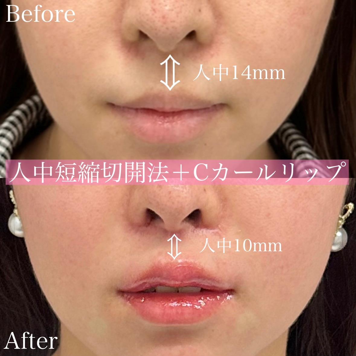 人中短縮手術(リフトアップ)の症例写真