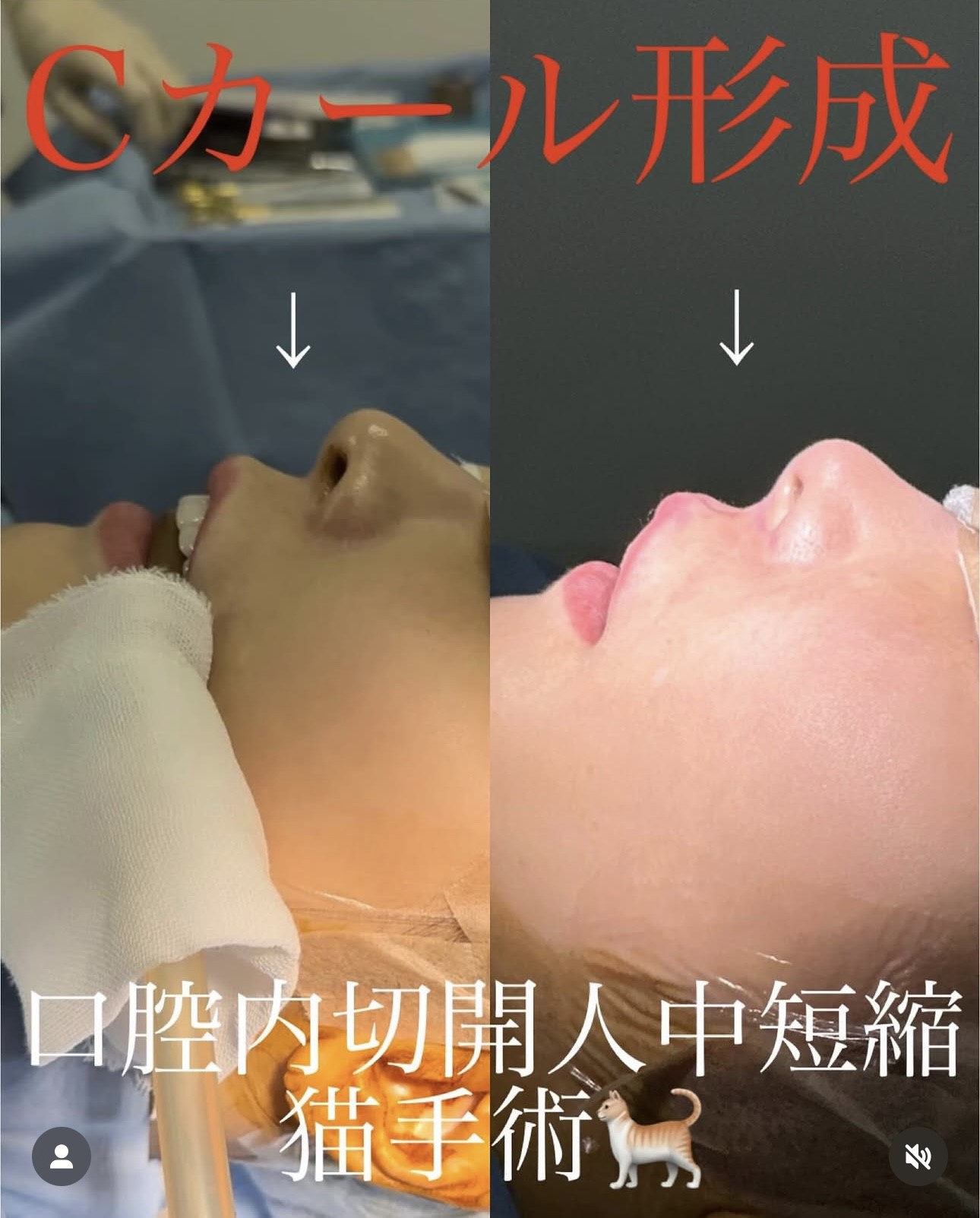 人中短縮手術(リフトアップ)の症例写真