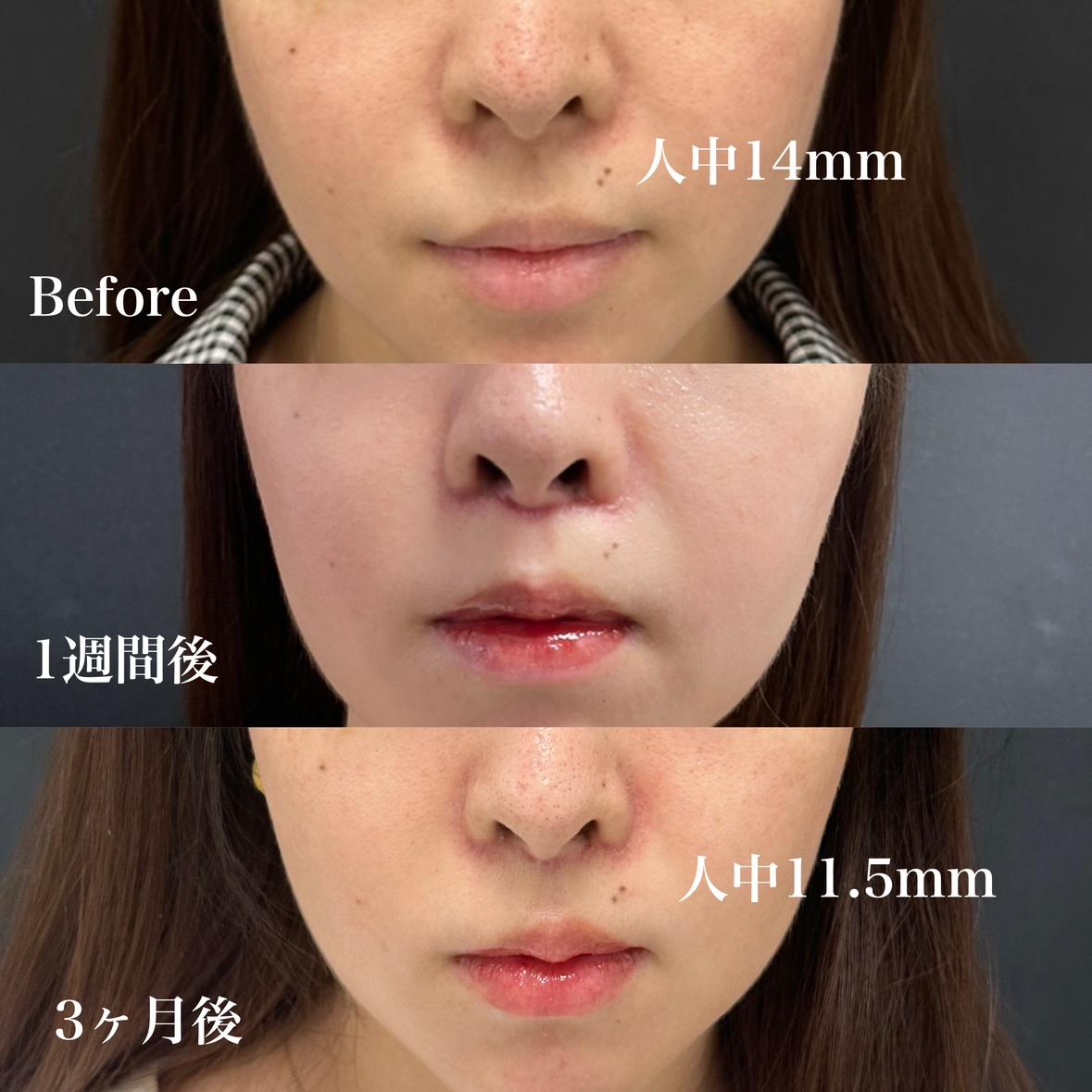 人中短縮手術(リフトアップ)の症例写真