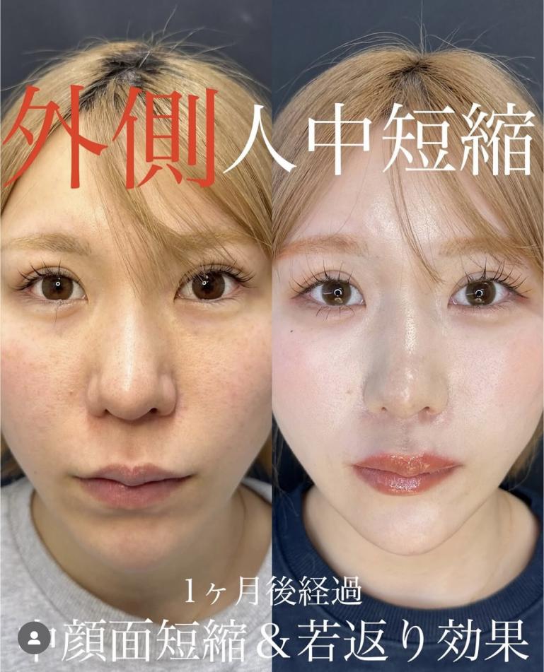 人中短縮手術(リフトアップ)の症例写真
