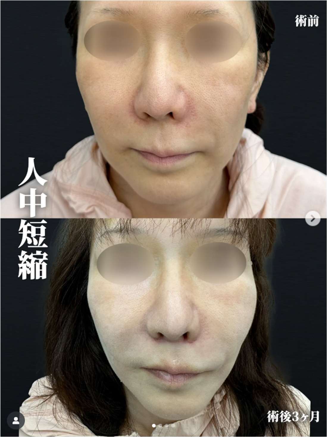 人中短縮手術(リフトアップ)の症例写真