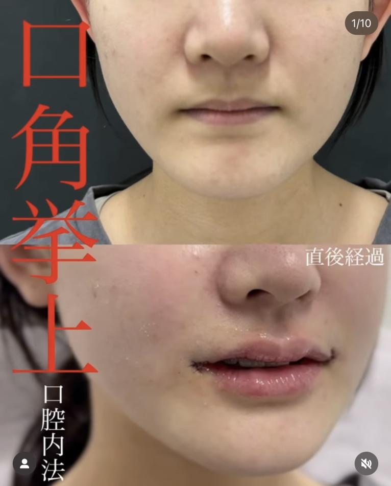 口角挙上（口角リフト）の症例写真