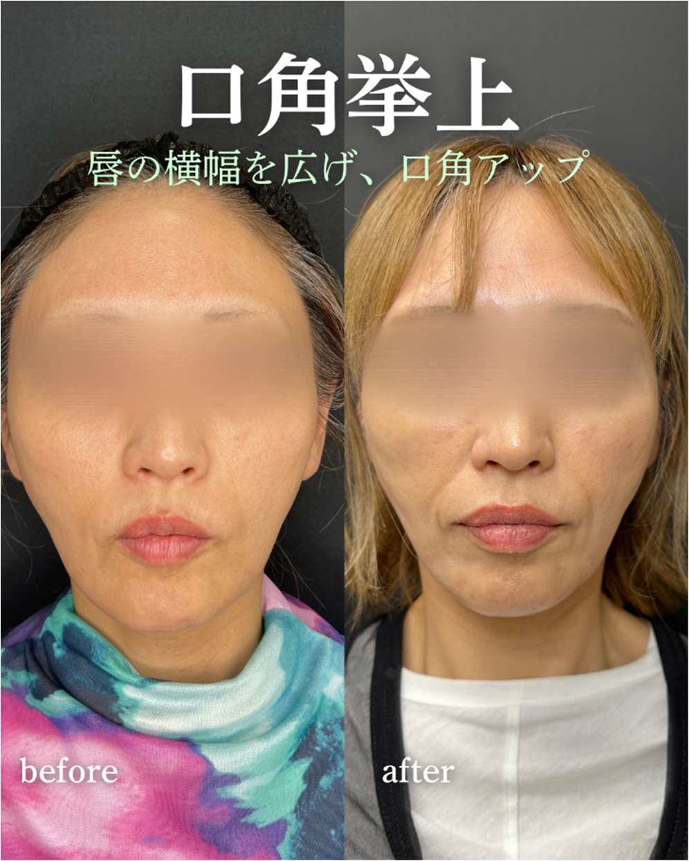 口角挙上（口角リフト）の症例写真