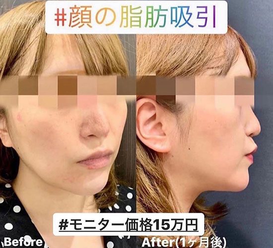 脂肪吸引の症例写真