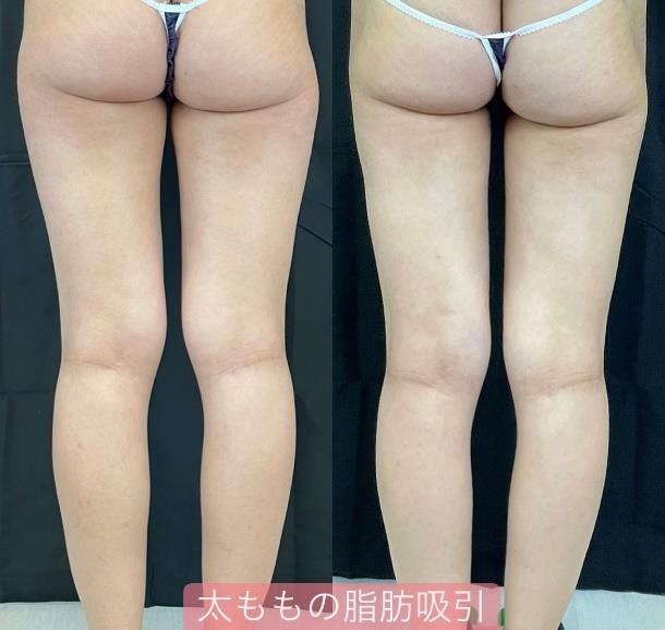 脂肪吸引の症例写真