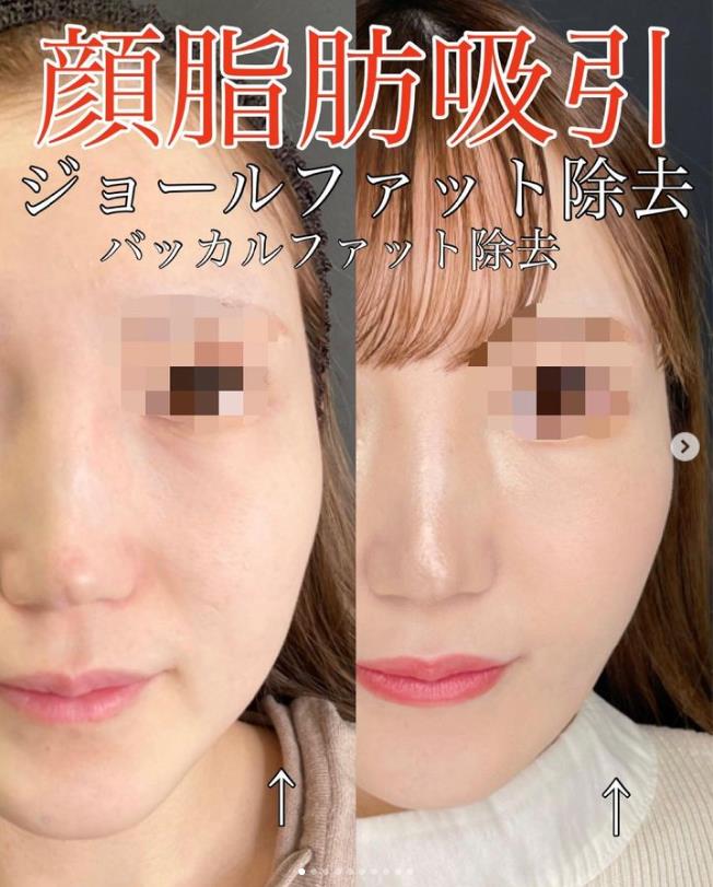 脂肪吸引の症例写真
