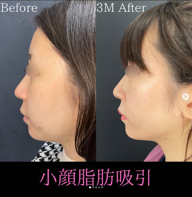 脂肪吸引の症例写真