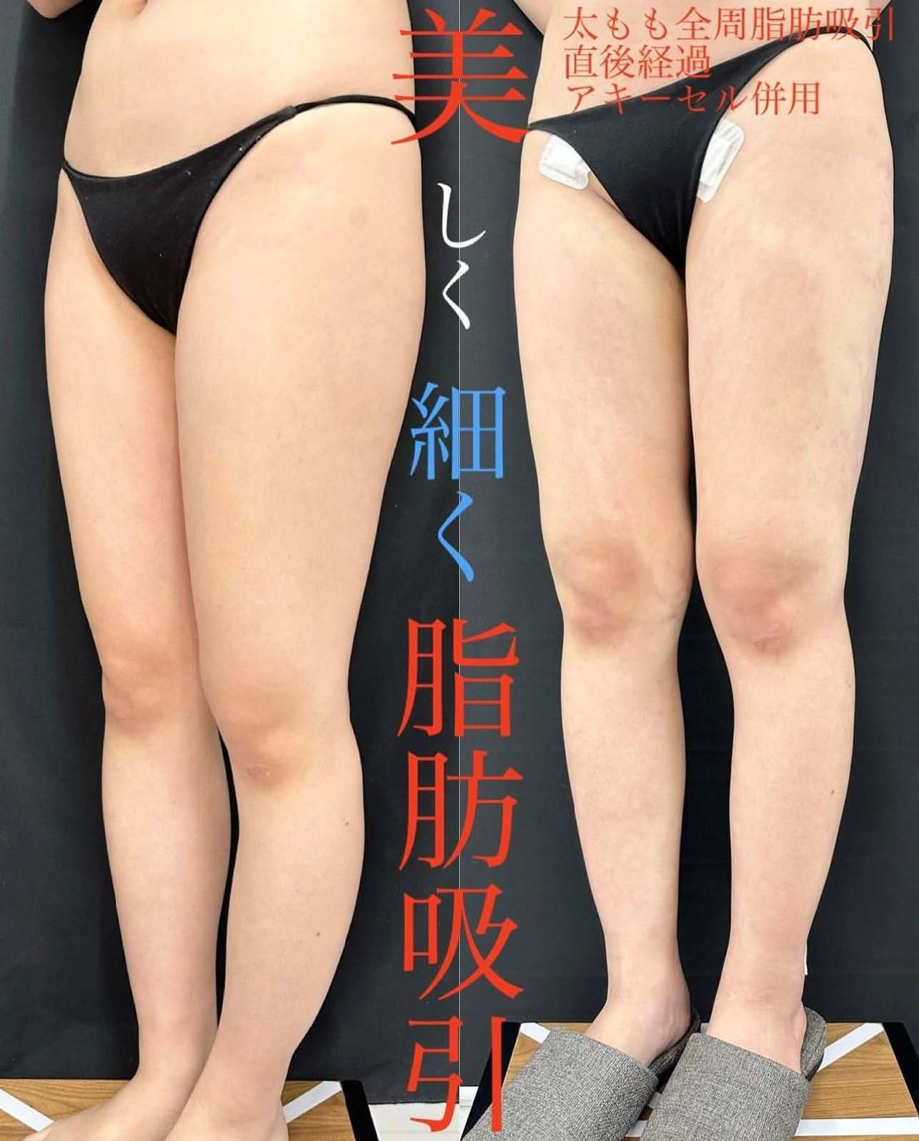 脂肪吸引の症例写真
