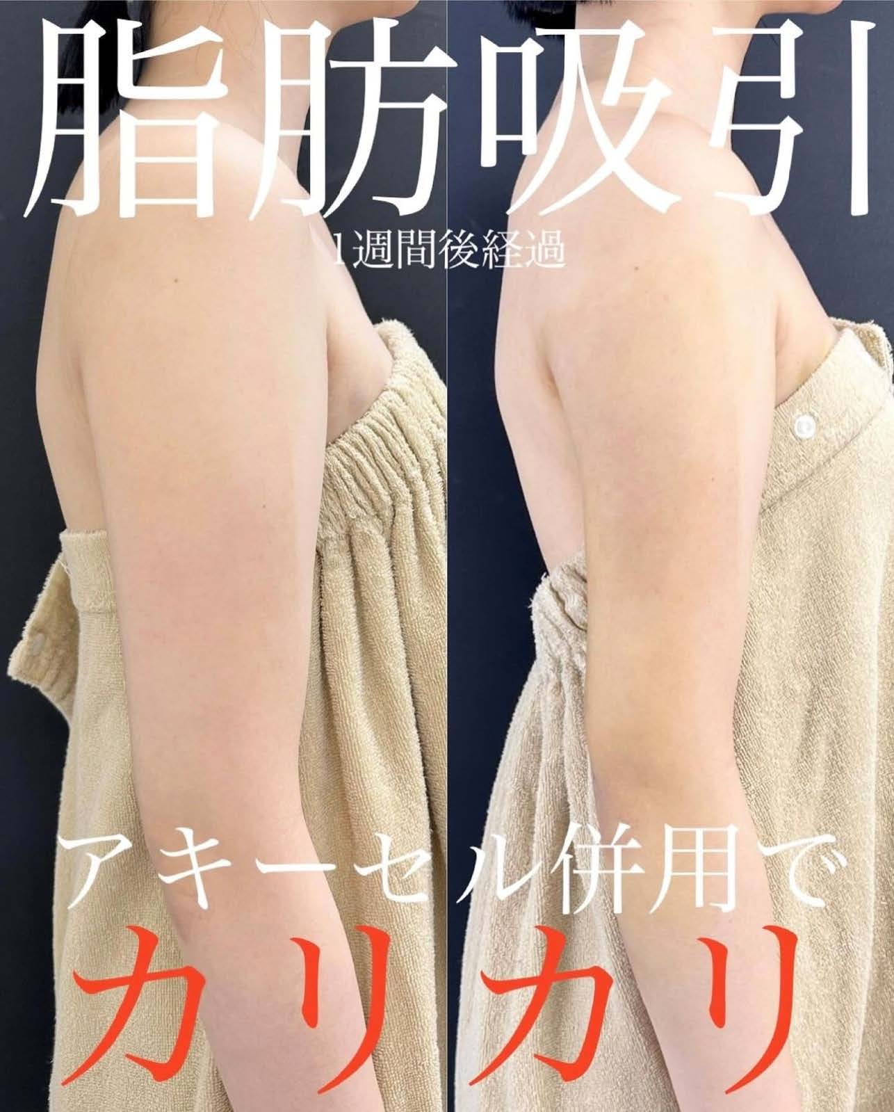脂肪吸引の症例写真