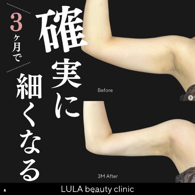 脂肪吸引の症例写真