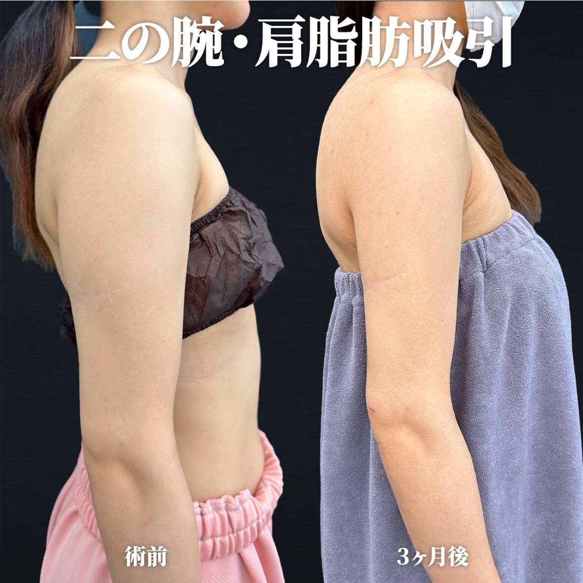 脂肪吸引の症例写真