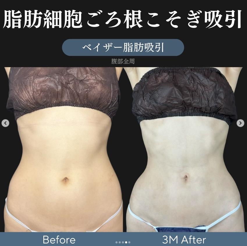 脂肪吸引の症例写真