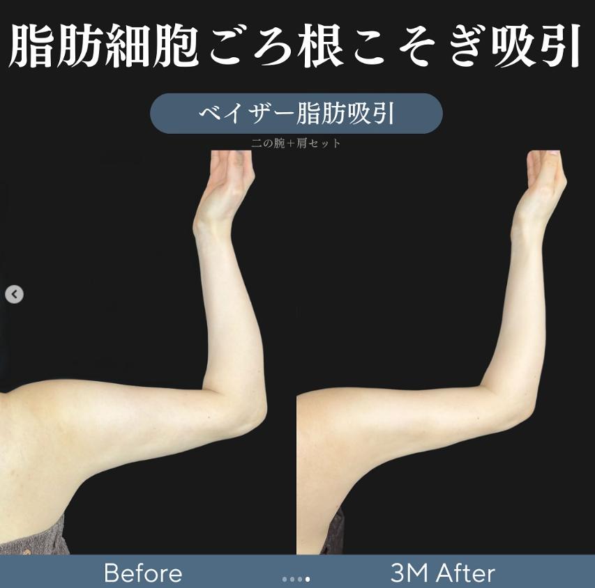 脂肪吸引の症例写真