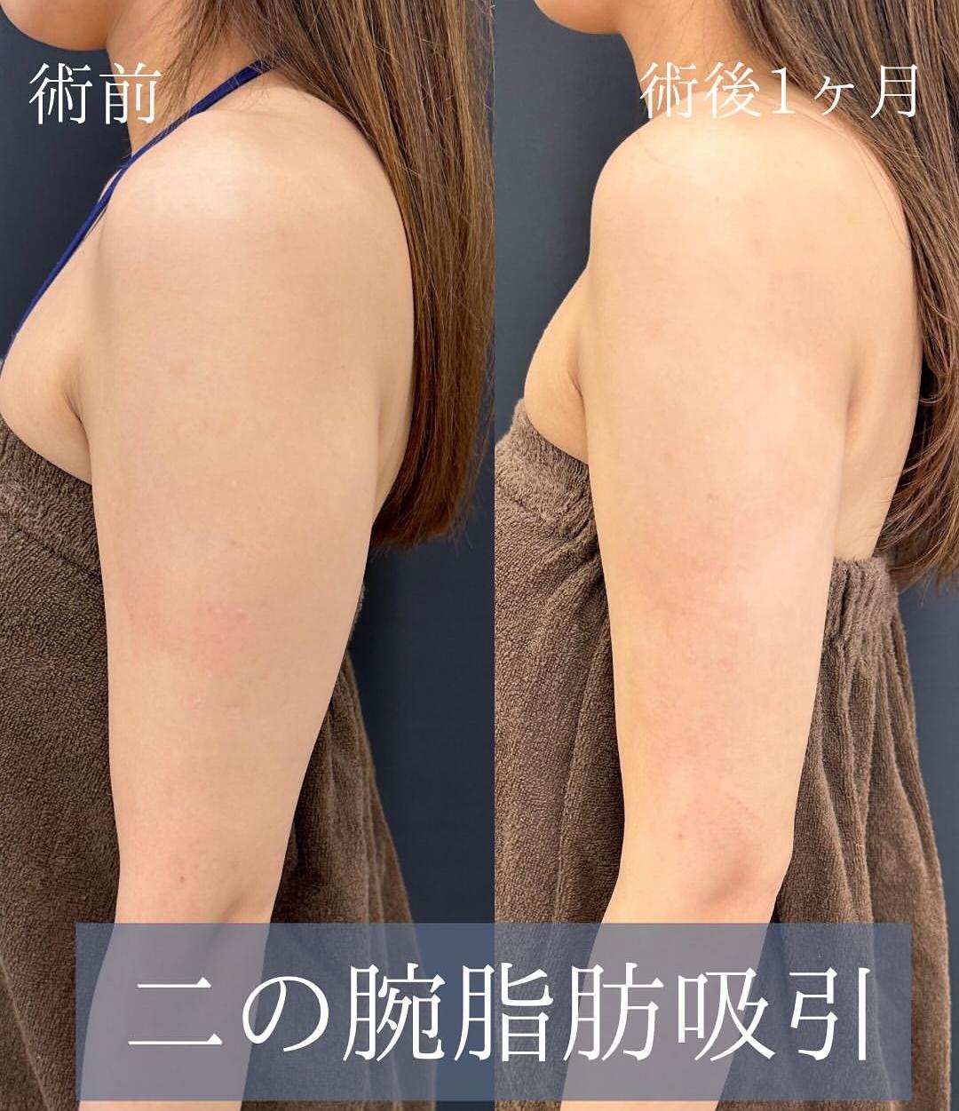 脂肪吸引の症例写真