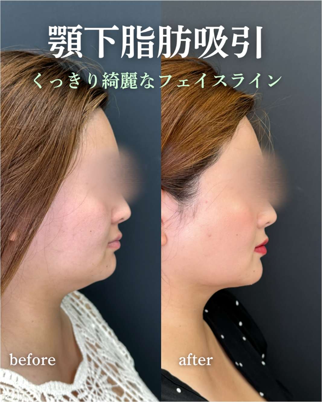 脂肪吸引の症例写真