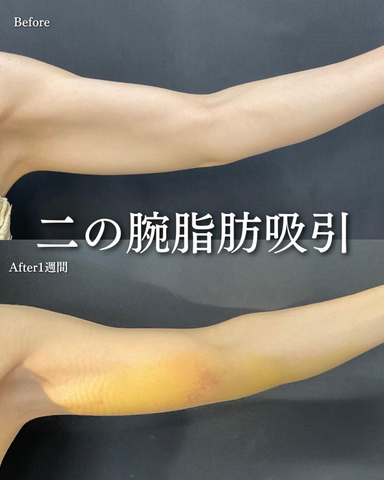 脂肪吸引の症例写真