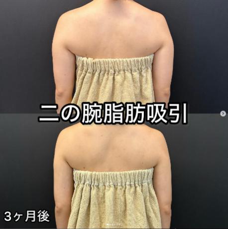 脂肪吸引の症例写真