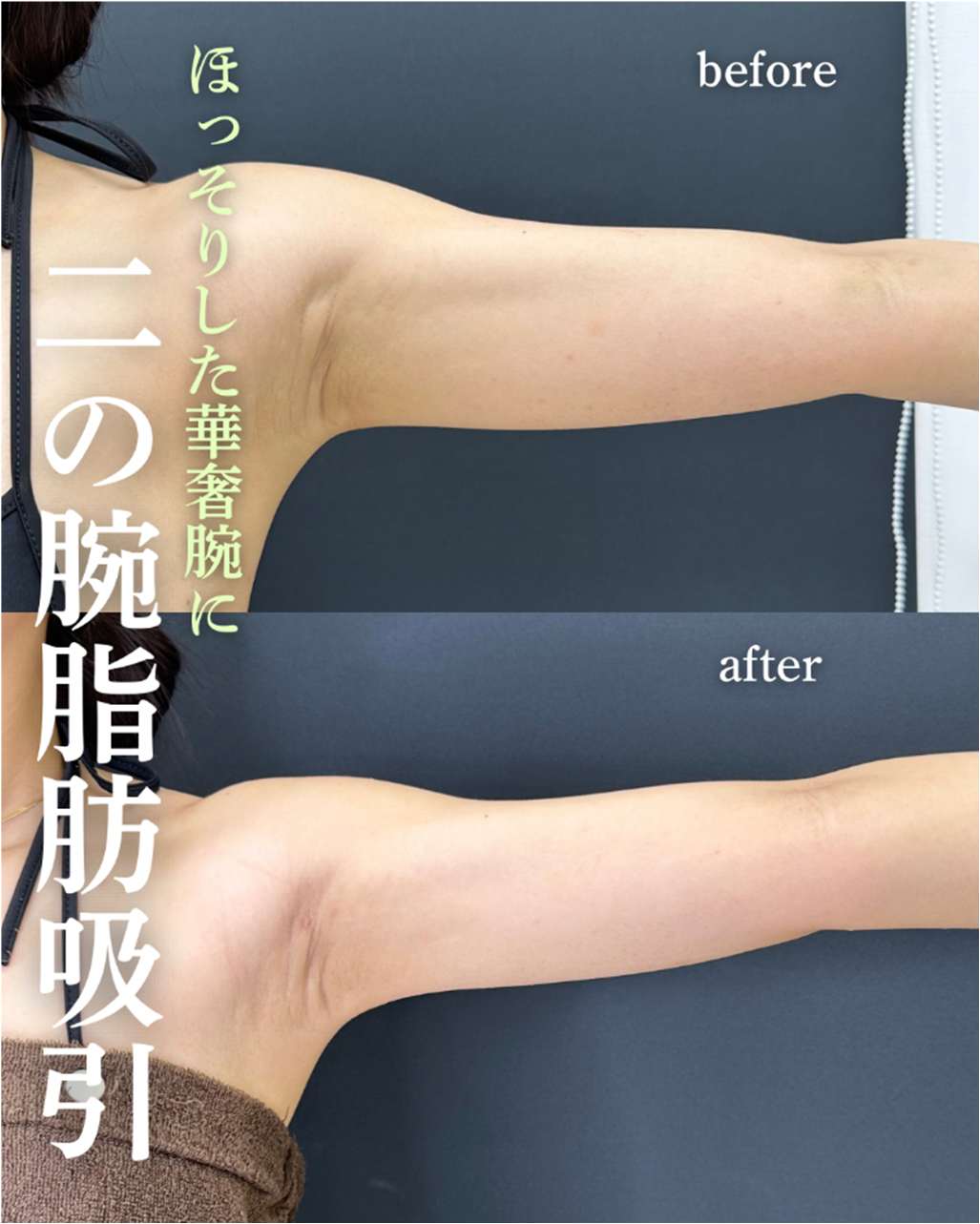 脂肪吸引の症例写真