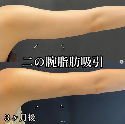 脂肪吸引の症例写真