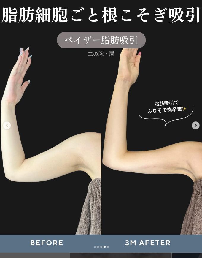 脂肪吸引の症例写真