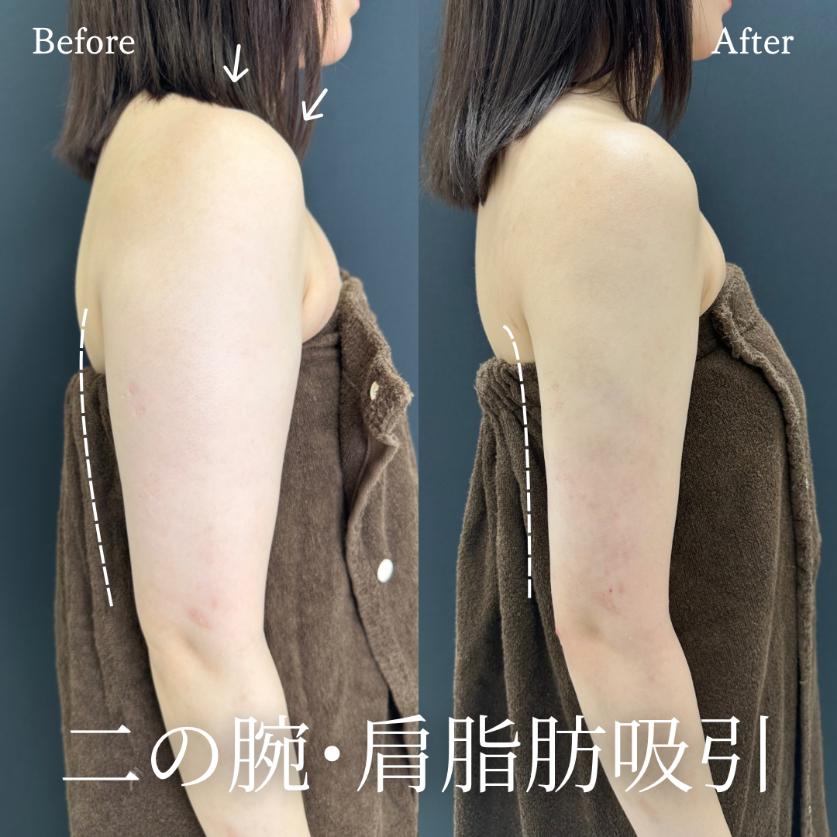 脂肪吸引の症例写真