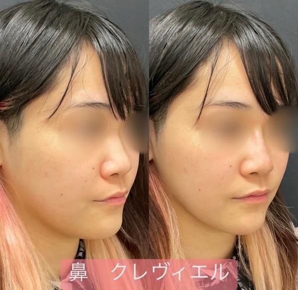 鼻ヒアルロン酸注入の症例写真