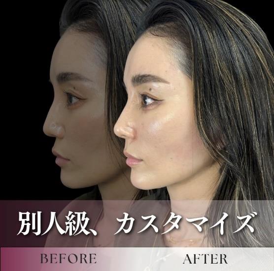 鼻ヒアルロン酸注入の症例写真
