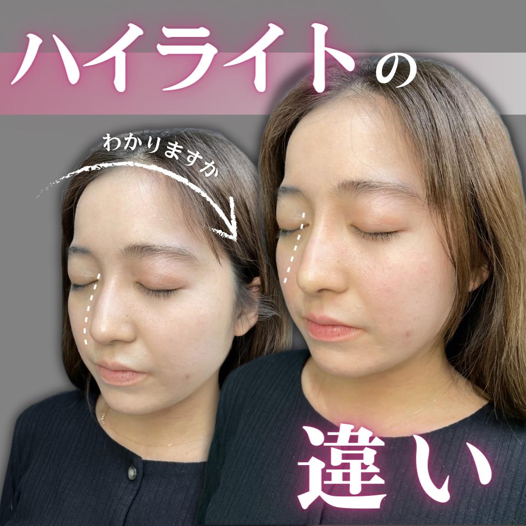 鼻ヒアルロン酸注入の症例写真