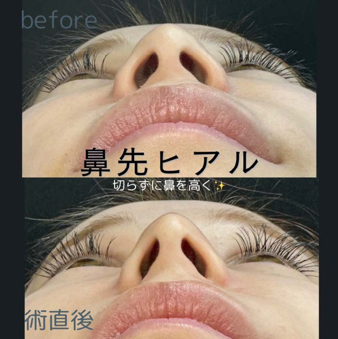 鼻ヒアルロン酸注入の症例写真