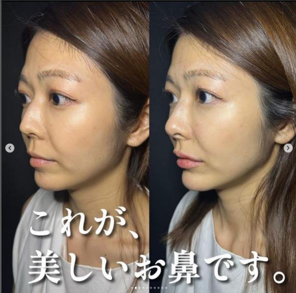 鼻ヒアルロン酸注入の症例写真