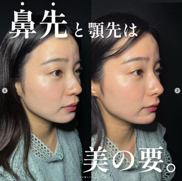 鼻ヒアルロン酸注入の症例写真