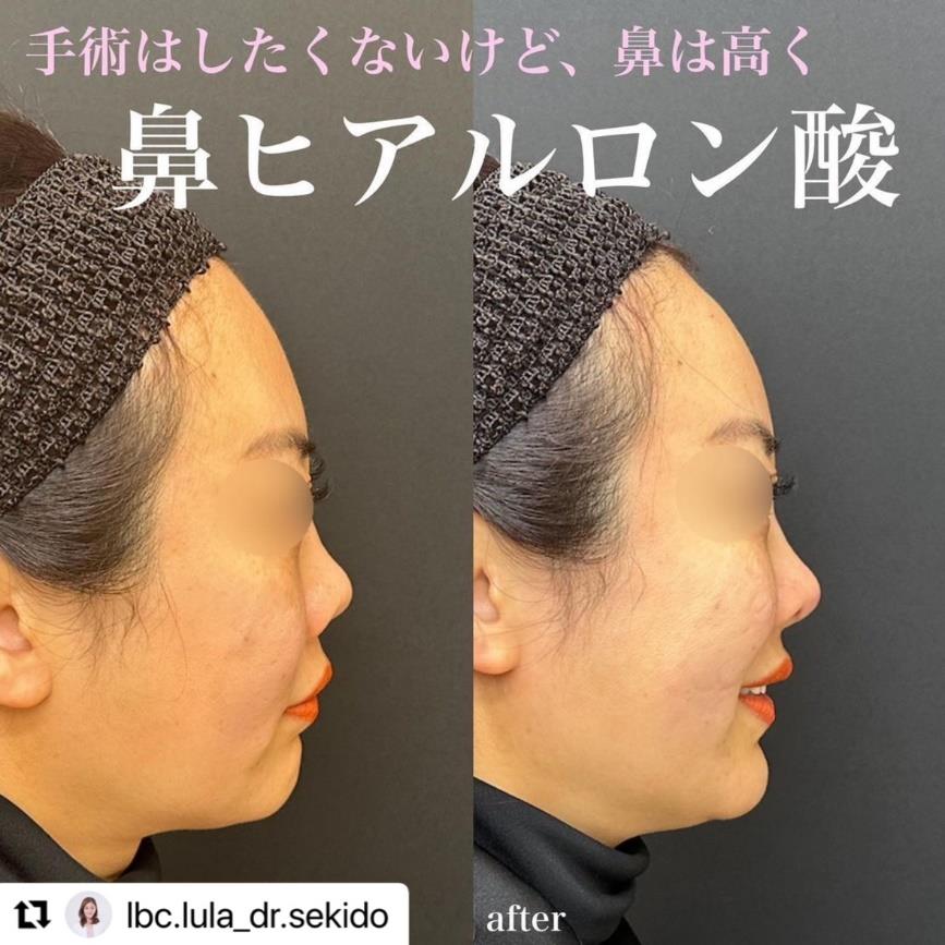 鼻ヒアルロン酸注入の症例写真