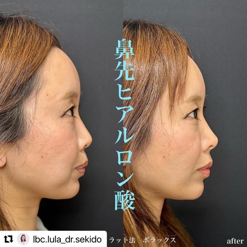 鼻ヒアルロン酸注入の症例写真