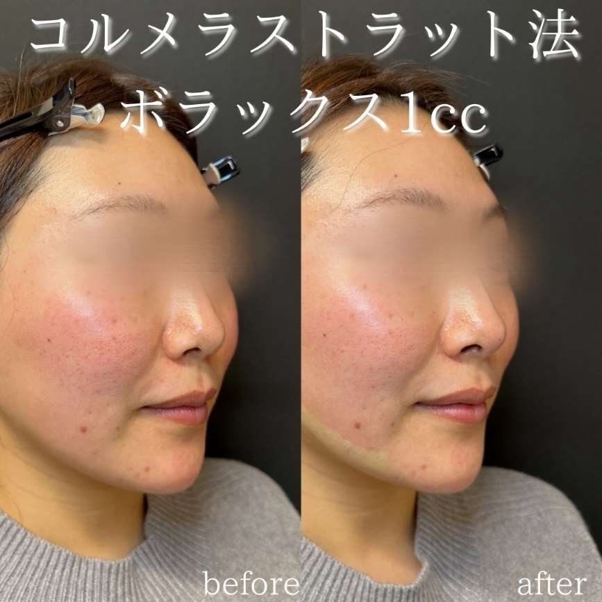 鼻ヒアルロン酸注入の症例写真