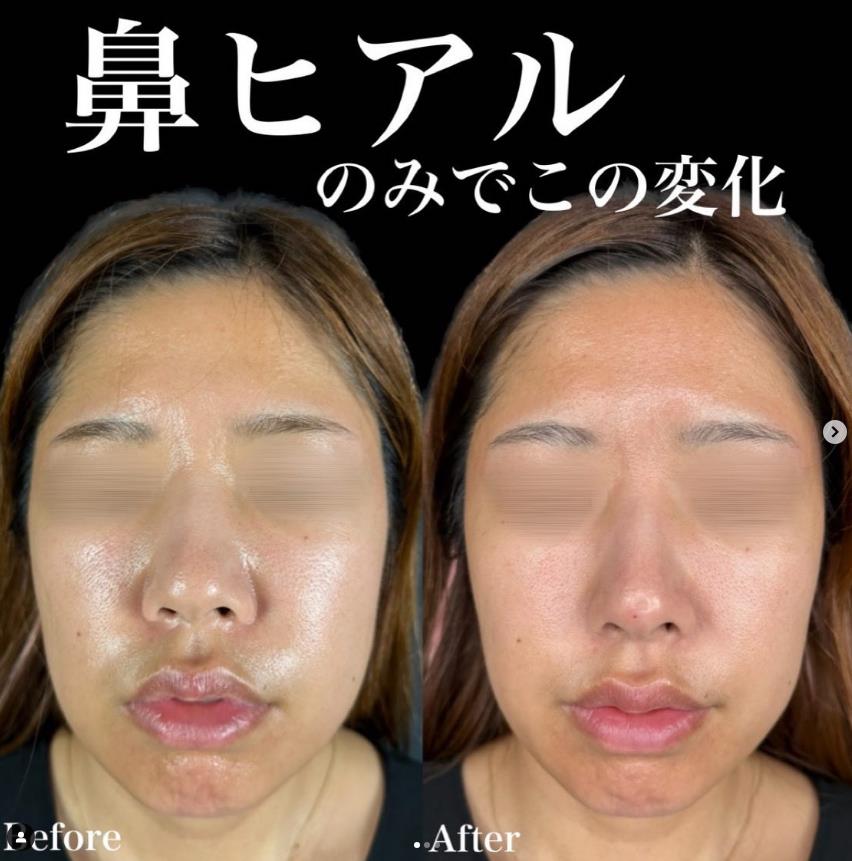 鼻ヒアルロン酸注入の症例写真
