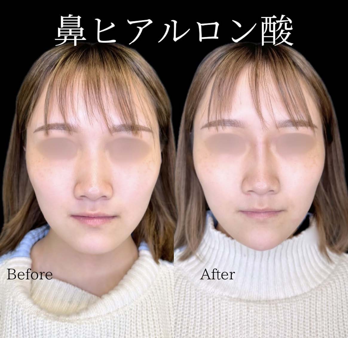 鼻ヒアルロン酸注入の症例写真