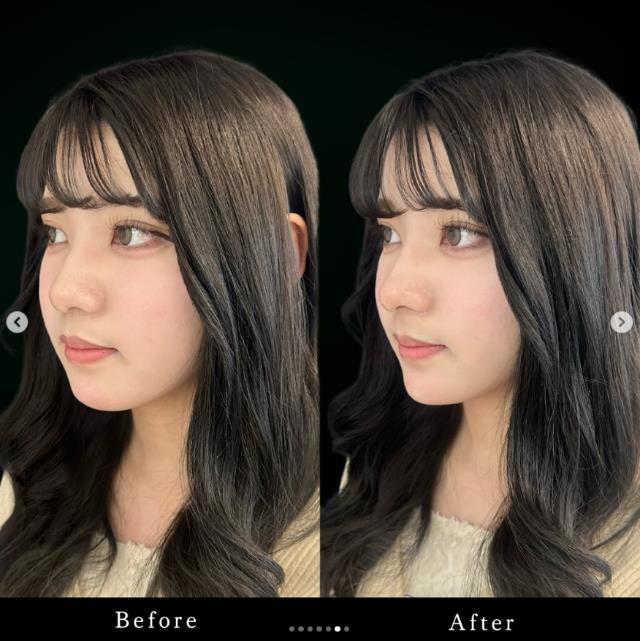 鼻ヒアルロン酸注入の症例写真