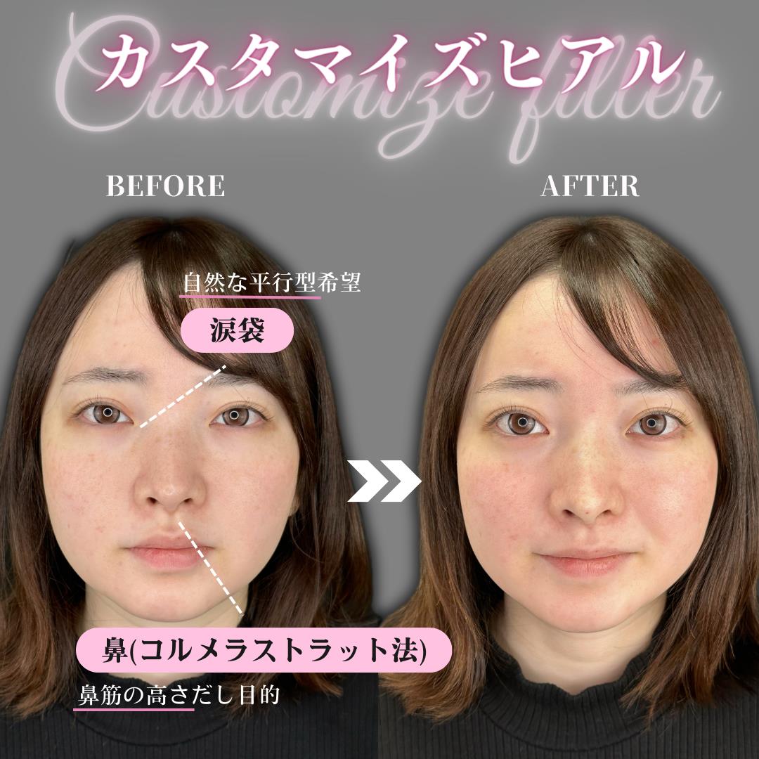鼻ヒアルロン酸注入の症例写真