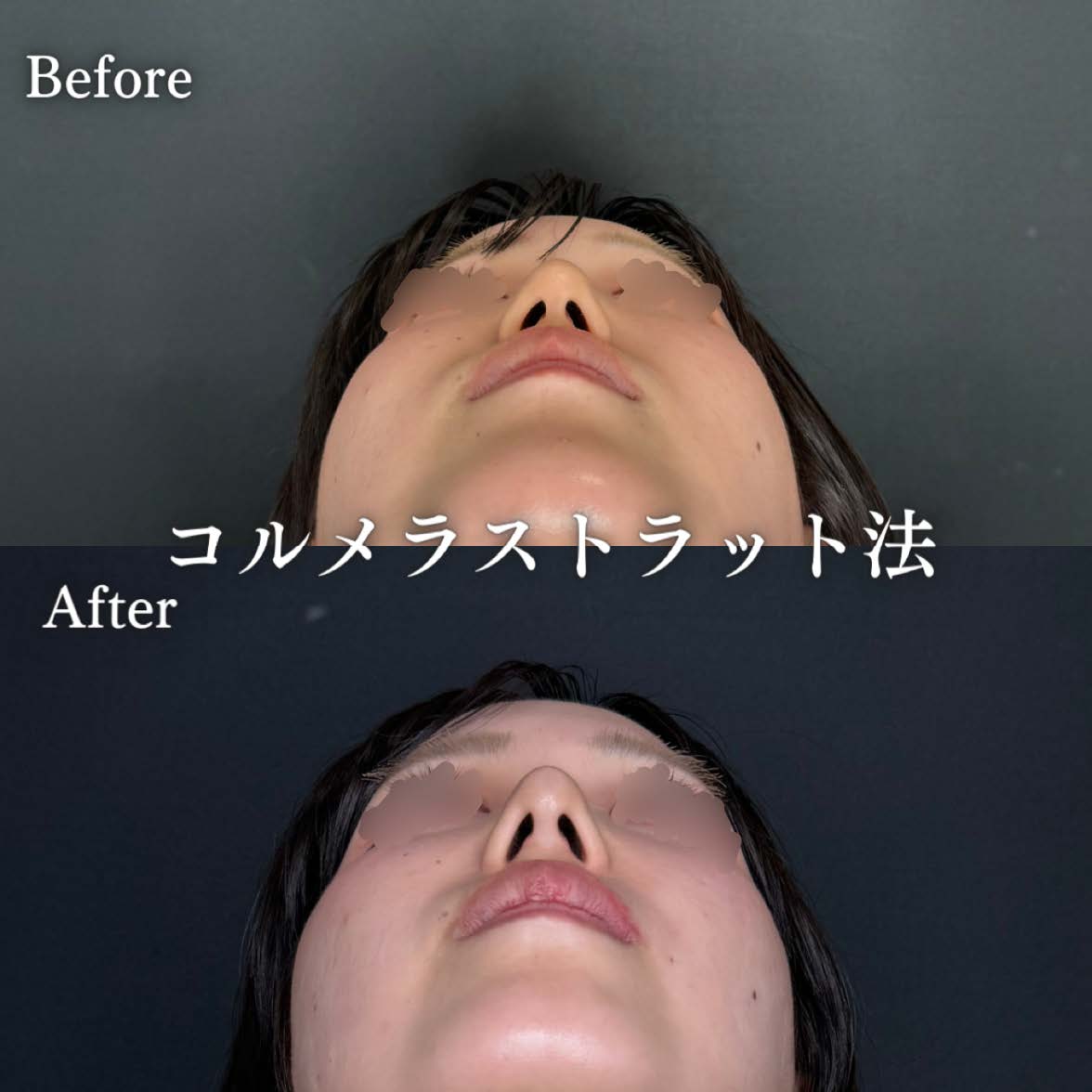 鼻ヒアルロン酸注入の症例写真